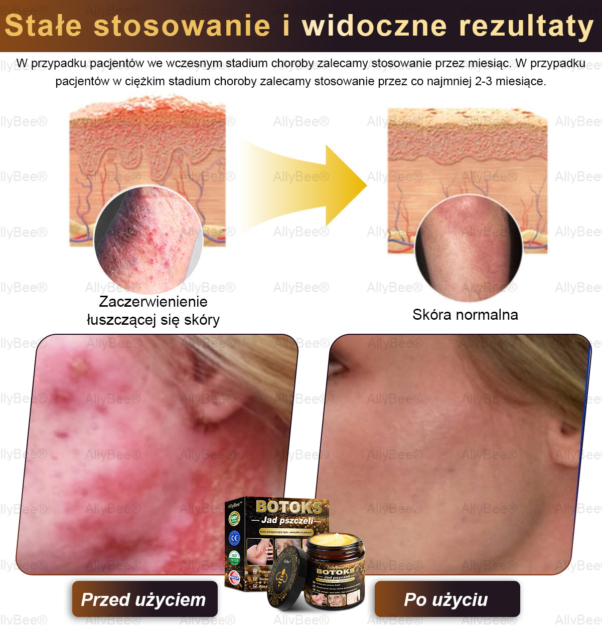 👨🔬 AllyBee® Krem Botox do pielęgnacji skóry - Wygładzanie zmarszczek, Nawilżenie, Regeneracja skóry, Wyrównanie kolorytu skóry, Leczenie trądziku i przebarwień, Usuwanie brodawek i znamion.--pl