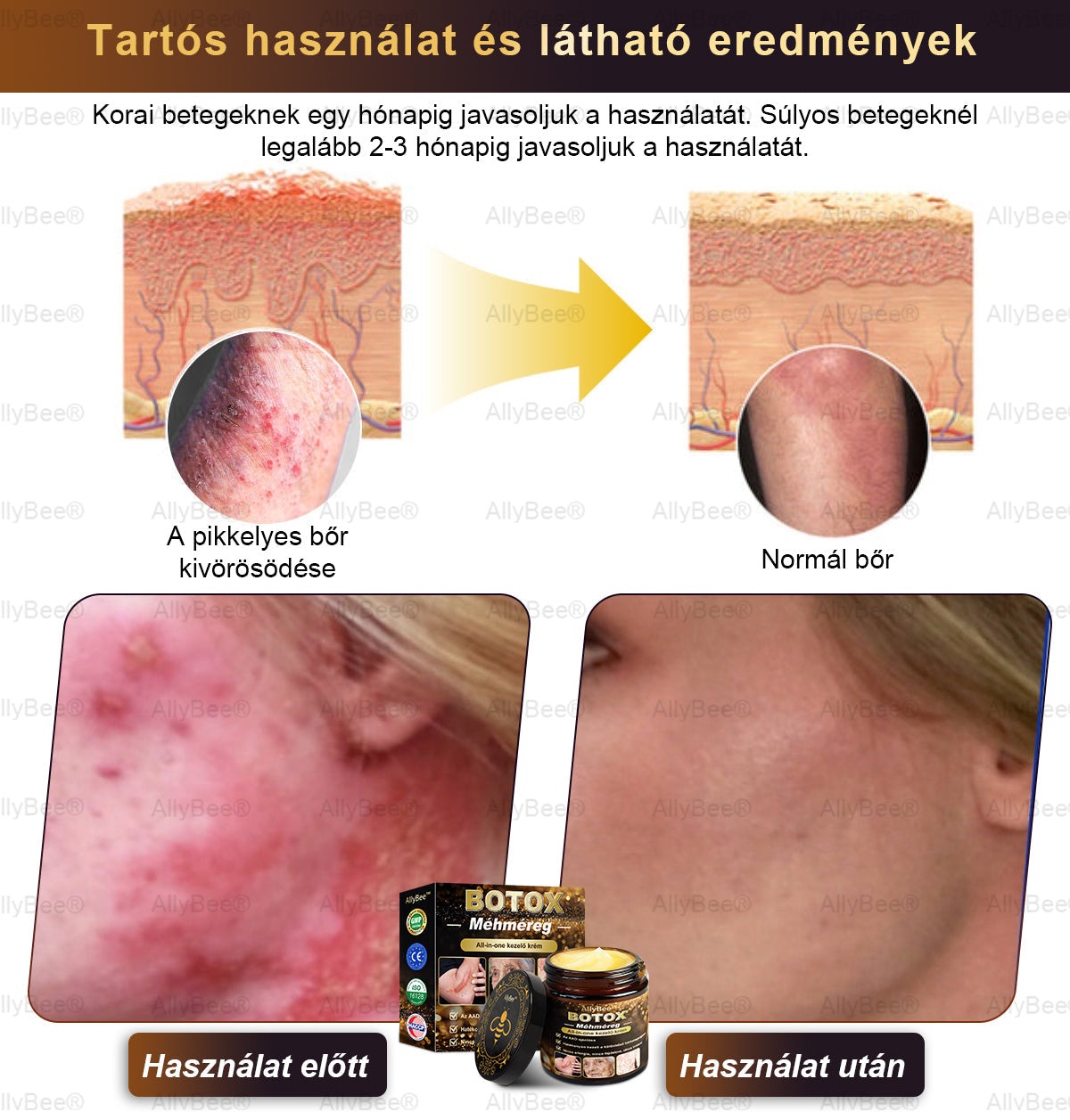 đAllyBeeÂź Botox BĆrĂĄpolĂł KrĂ©m RĂĄnctalanĂtĂĄs, HidratĂĄlĂĄs, BĆrregenerĂĄlĂĄs, Egyenletes BĆrtĂłnus, PattanĂĄs- Ă©s SötĂ©tfolt KezelĂ©s, Szemölcs- Ă©s Anyajegyek EltĂĄvolĂtĂĄsa