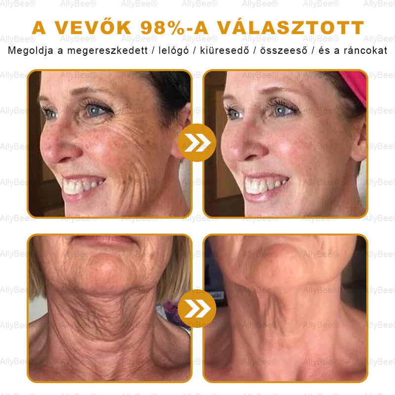 đAllyBeeÂź Botox BĆrĂĄpolĂł KrĂ©m RĂĄnctalanĂtĂĄs, HidratĂĄlĂĄs, BĆrregenerĂĄlĂĄs, Egyenletes BĆrtĂłnus, PattanĂĄs- Ă©s SötĂ©tfolt KezelĂ©s, Szemölcs- Ă©s Anyajegyek EltĂĄvolĂtĂĄsa