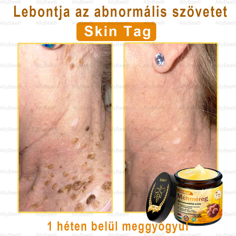 Mayo Clinic tisztviselő: AllyBee® bőrkezelő krém öregedésgátló, hidratáló, bőrjavító, egyenletes tónus, pattanások és sötét foltok kezelése, szemölcs és anyajegy eltávolítása, pikkelysömör enyhítése