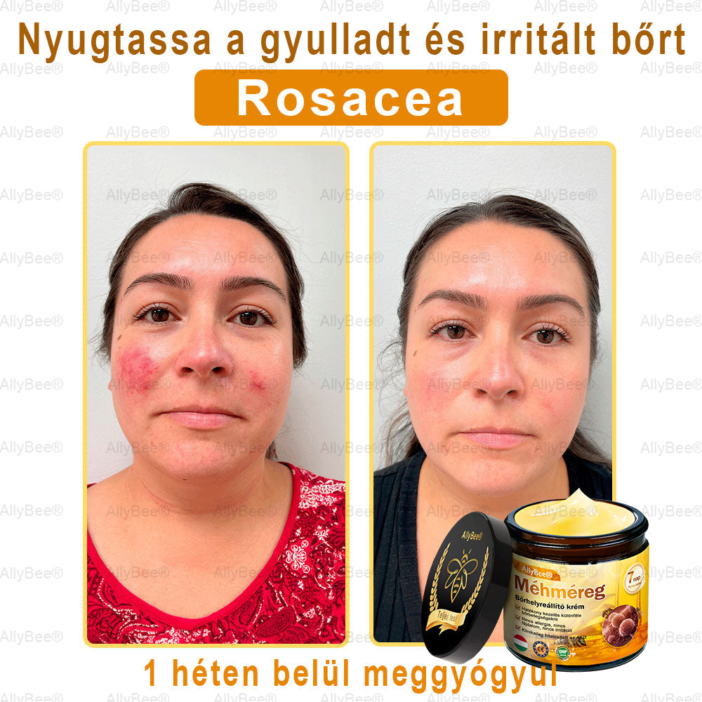 Mayo Clinic tisztviselő: AllyBee® bőrkezelő krém öregedésgátló, hidratáló, bőrjavító, egyenletes tónus, pattanások és sötét foltok kezelése, szemölcs és anyajegy eltávolítása, pikkelysömör enyhítése