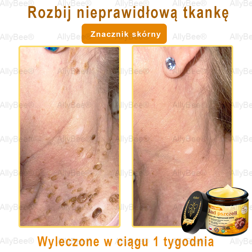 AllyBee® Krem do pielęgnacji skóry – przeciwstarzeniowy, nawilżający, regenerujący skórę, wyrównujący koloryt, leczenie trądziku i ciemnych plam, usuwanie brodawek i znamion, ulga w łuszczycy.