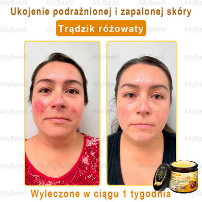 AllyBee® Krem do pielęgnacji skóry – przeciwstarzeniowy, nawilżający, regenerujący skórę, wyrównujący koloryt, leczenie trądziku i ciemnych plam, usuwanie brodawek i znamion, ulga w łuszczycy.